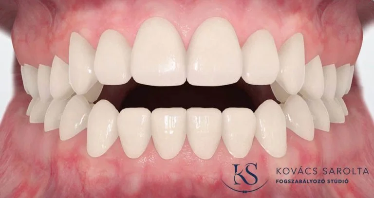 KS-Fogszabalyozo-studio-lathatalan-fogszabalyozas