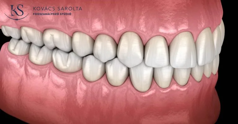 KS-Fogszabalyozo-studio-lathatalan-fogszabalyozas