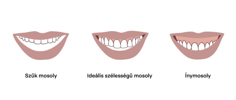 KS-Fogszabalyozo-studio-lathatalan-fogszabalyozas