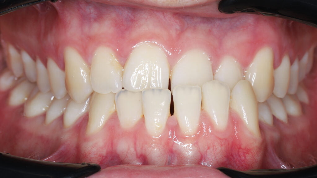 Orthodontics Treatment for Underbite or Crossbite - Rubber Bands 